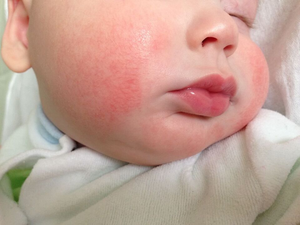 A sign of worms in a child is allergic urticaria